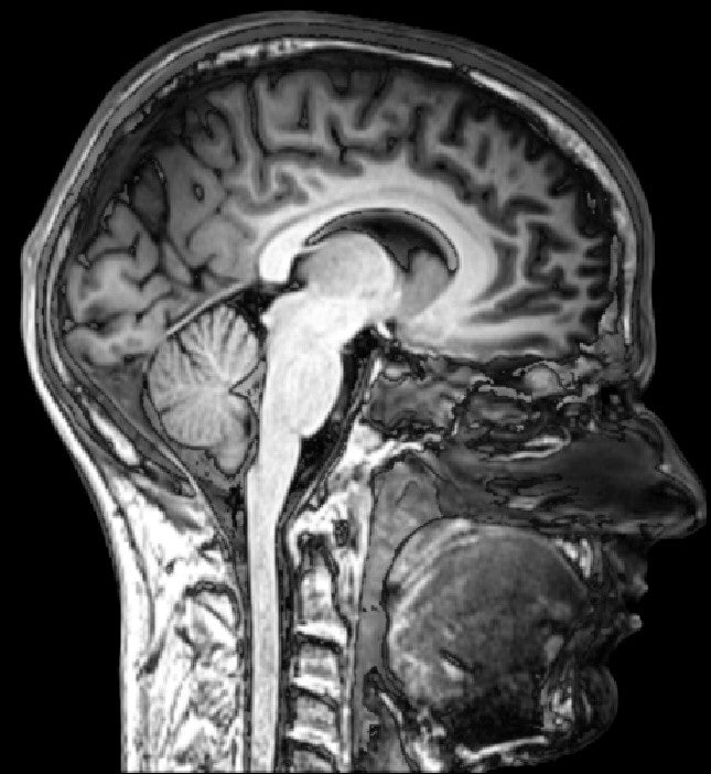 MRI-doorsnede van het menselijk brein, zijaanzicht